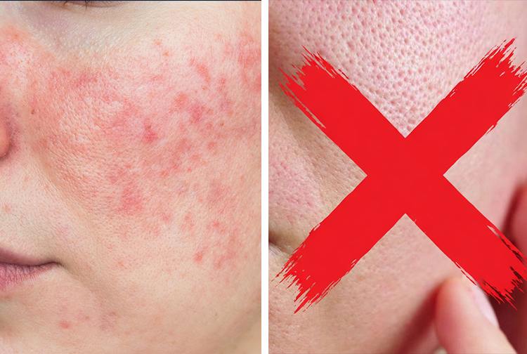 拒絕過度護膚,解鎖面部祛痘暗沉修護新方式