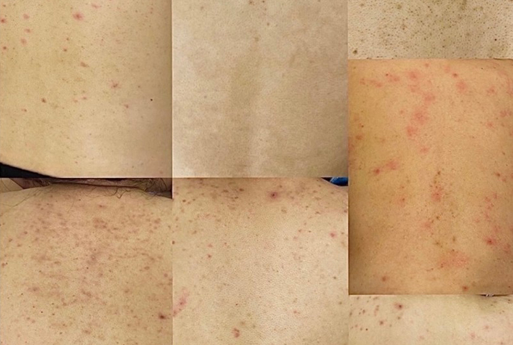 背部護膚易被忽視?Suey專屬方案,解決背部肌膚多重困擾